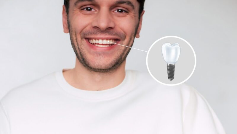 Common Myths About Dental Implants